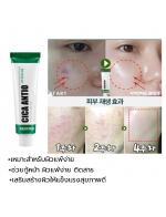 MEDI-PEEL Cica Antio Cream 30 ml. สุดยอดของเวชภัณฑ์สำอางเข้มข้นบำรุงผิวหน้าเหมาะสำหรับผิวเป็นสิวรักษา เห็นผลภายใน 7วัน หลอดสีเขียวเน้นรักษารอยที่เกิดจากสิวโดยเฉพาะ ฟื้นฟูกู้หน้าพัง MEDI-PEEL Cica Antio Cream 30 ml. สุดยอดของเวชภัณฑ์สำอางเข้มข้นบำรุงผิวหน้าเหมาะสำหรับผิวเป็นสิวรักษา เห็นผลภายใน 7วัน หลอดสีเขียวเน้นรักษารอยที่เกิดจากสิวโดยเฉพาะ ฟื้นฟูกู้หน้าพัง